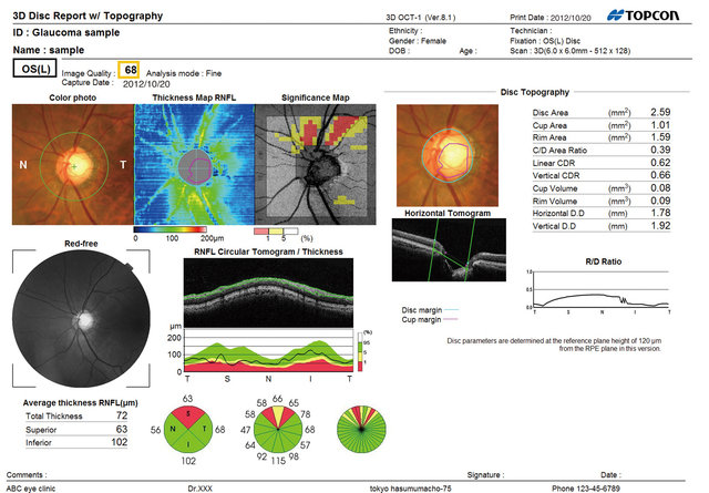 OCT glaucoma Scan report