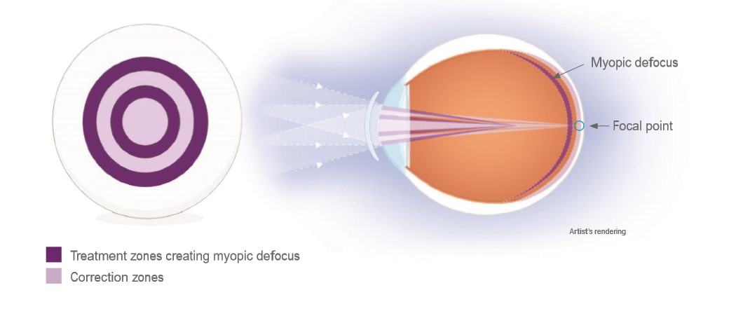 MiSight info